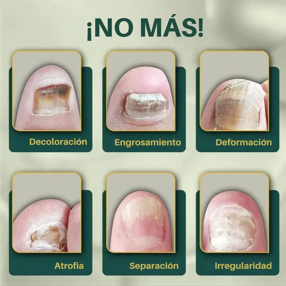 Uñas Libres de Hongos en 7 Días + Corta Uñas Gratis - Tratamiento Natural y Efectivo