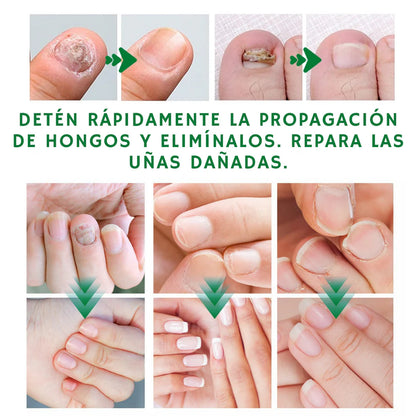 Uñas Libres de Hongos en 7 Días + Corta Uñas Gratis - Tratamiento Natural y Efectivo